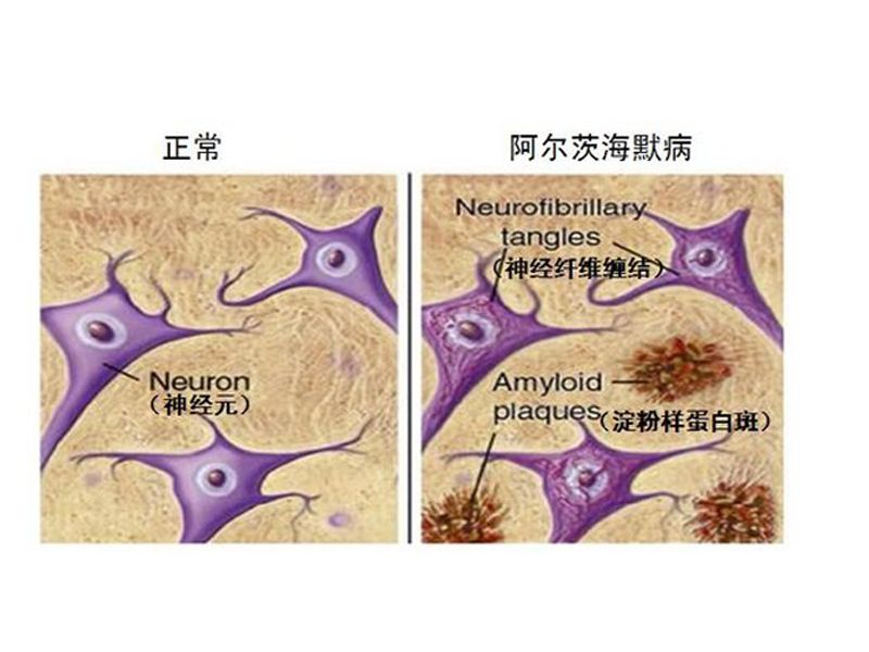 Read more about the article BioVision阿尔茨海默病检测相关试剂盒